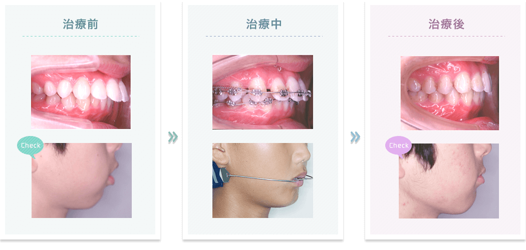 治療例…上顎前突（非抜歯HG）